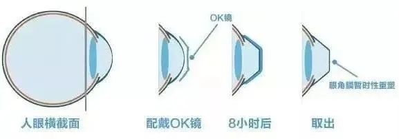进口医疗器械角膜塑形镜若何报关？